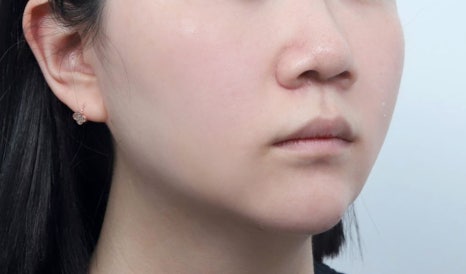 Thread-Lifting Swelling: Tips for Managing Swelling for a Quick Return to Daily Life image 3