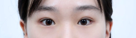Worried About Re-adhesion After Lateral Canthoplasty? Those Concerns Disappear When the Surgical Technique Is Different image 3