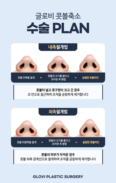 콧볼축소 부작용? 절개 위치부터 확인하세요 관련 이미지 2