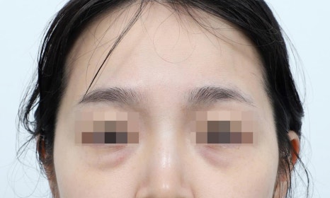 강남 눈밑지방재배치, 눈 밑 지방을 정리하는 방법 관련 이미지 8