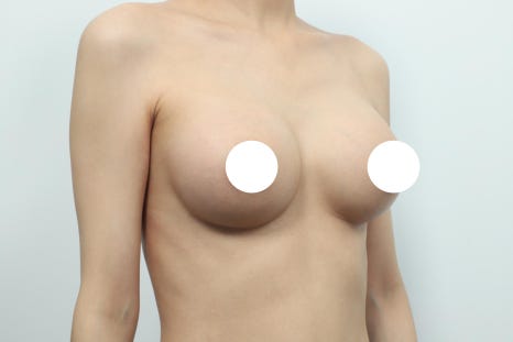 When Is the Right Time for Breast Revision Surgery in Gangnam? image 5