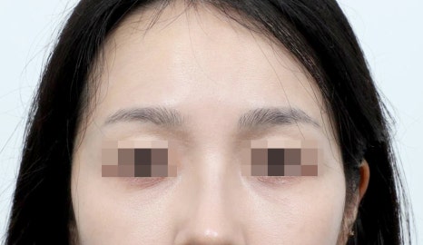 눈밑지방재배치 복시 생기면 이상한 걸까요 관련 이미지 3