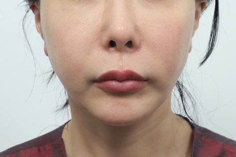Philtrum Reduction for Middle-Aged Patients: Correcting the Lengthening Area Between the Nose and Upper Lip with Age image 5