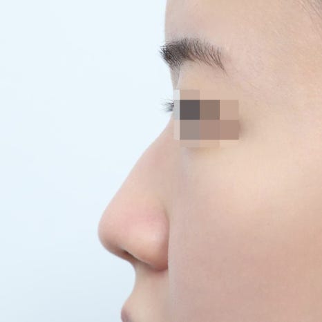 Tips for Managing the Recovery Period After Summer Vacation Rhinoplasty image 4