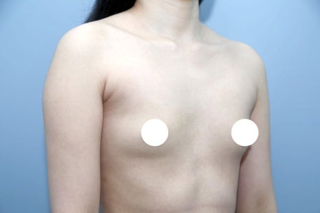 절벽가슴수술, 보형물만으로 될까요? 모양 교정이 따로 필요한 이유 관련 이미지 3