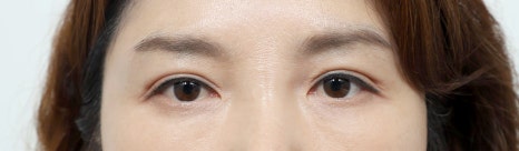 Double Eyelid Surgery in Middle Age: Improving Drooping Eyelids and Differences from Upper Blepharoplasty image 3