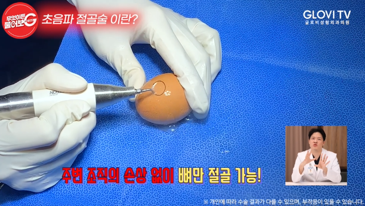 압구정역성형외과 코성형, 초음파절골술로 안전하게 관련 이미지 13