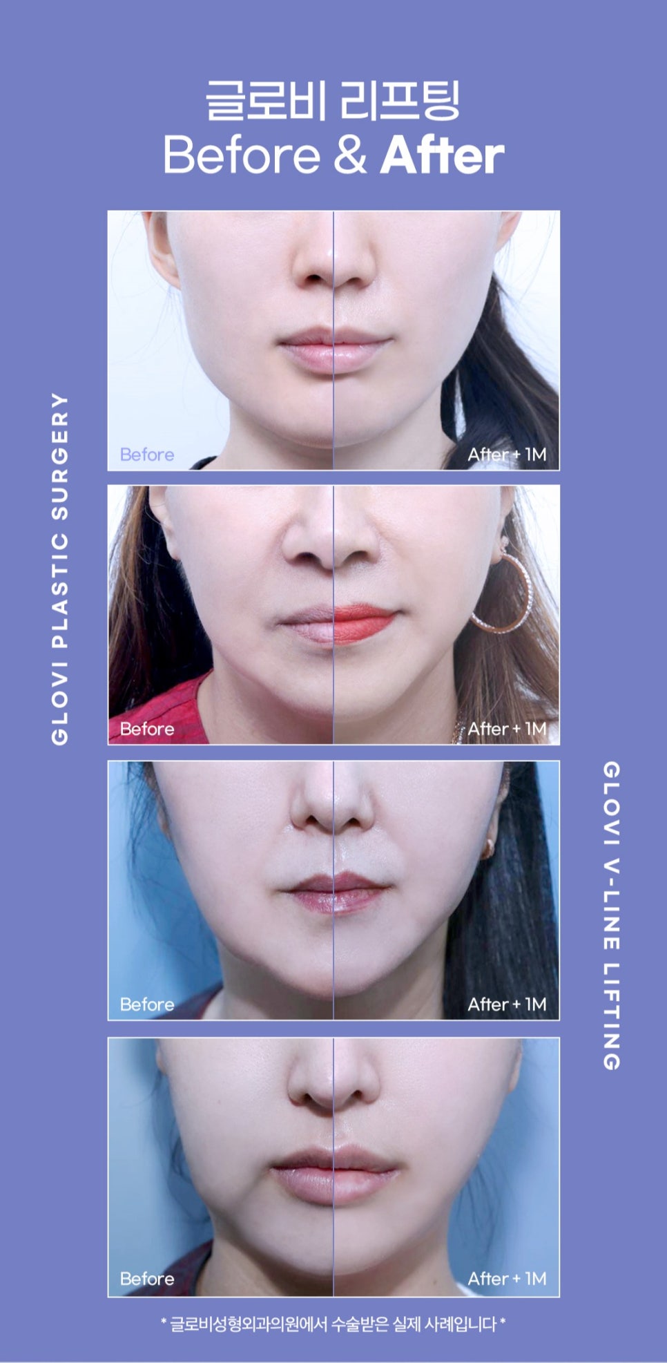 압구정 실리프팅 유지기간 효과가 궁금하다면 관련 이미지 6