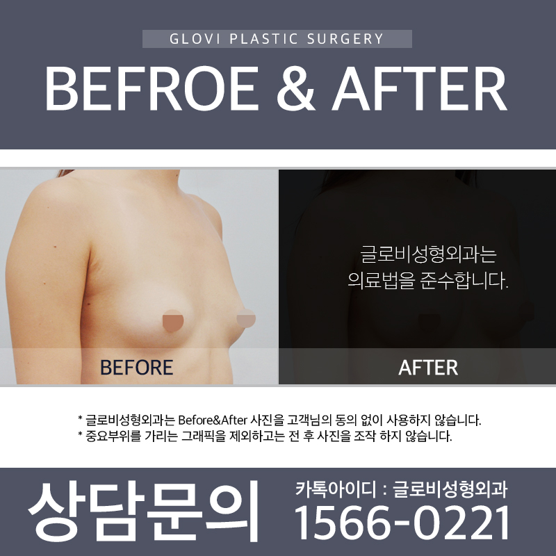 글로비성형외과 가슴성형 관련 이미지 2