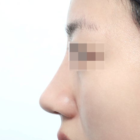 Rib Cartilage Rhinoplasty: When Rib Cartilage Is Used in Rhinoplasty image 9