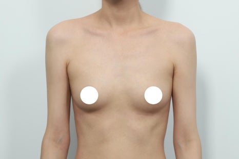 When Is the Right Time for Breast Revision Surgery in Gangnam? image 4