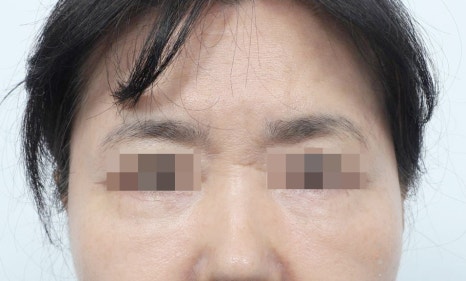 중년 눈밑주름없애는방법, 화장으로도 안 가려진다면 관련 이미지 5