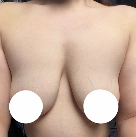 When Is the Right Time for Breast Revision Surgery in Gangnam? image 8