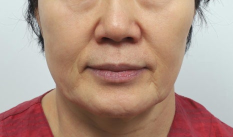 실리프팅 비용, 왜 병원마다 이렇게 다를까요 관련 이미지 6