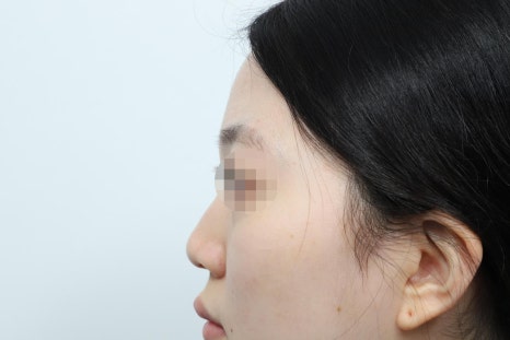 비중격 코성형 특징과 수술 전 확인해야 할 장단점 관련 이미지 5