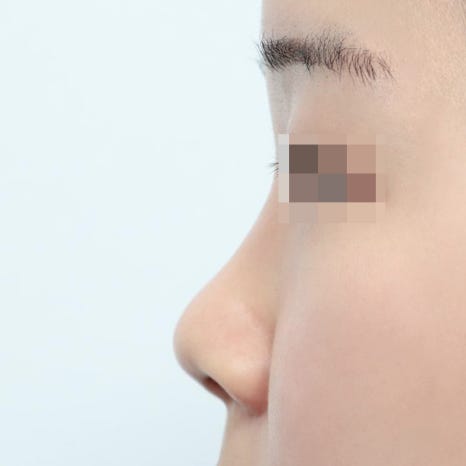 The Process of Autologous Rib Cartilage Rhinoplasty and Its Advantages and Disadvantages Compared with Implants image 5