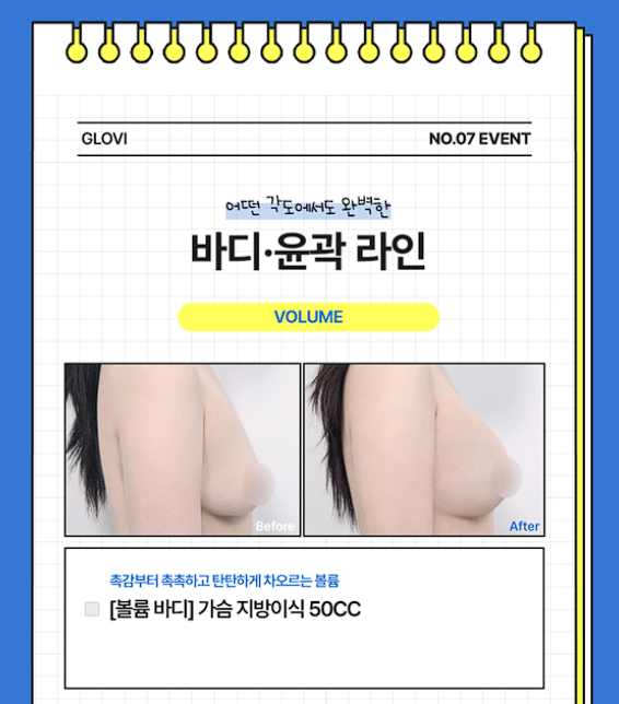 [글로비성형외과] 여름방학 이벤트! 눈&middot;코&middot;바디 라인 혜택 정리 관련 이미지 5