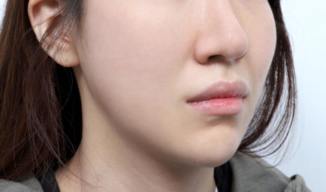 Why You May Regret Choosing a Thread Lift Based on Cost Alone image 5