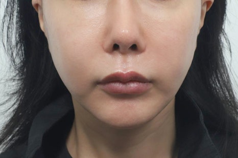 Philtrum Reduction for Middle-Aged Patients: Correcting the Lengthening Area Between the Nose and Upper Lip with Age image 6