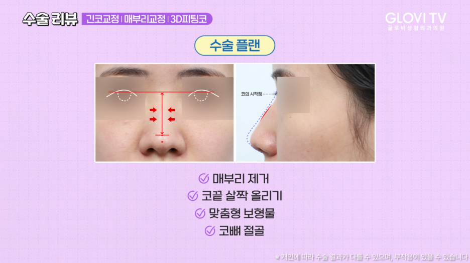 매부리코 긴코 코성형 리뷰, 글로비 3D 피팅코수술 관련 이미지 6