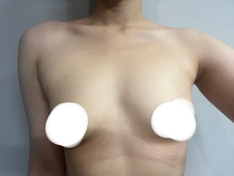 가슴성형 종류, 보형물 선택 시 놓치지 말아야 할 것 관련 이미지 8