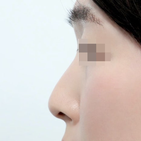 Natural-Yet-Glamorous Rhinoplasty: Is It Possible to Achieve Both Glamour and Naturalness? image 7