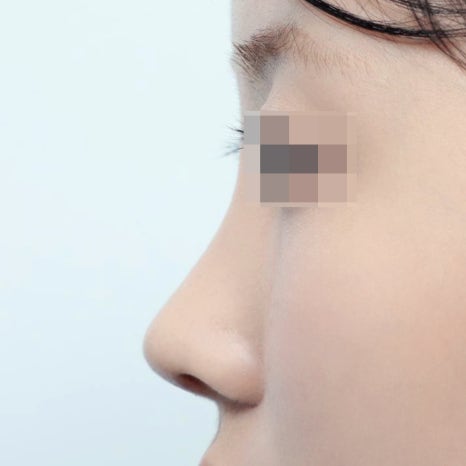 자가연골 코성형 비용, 왜 이렇게 차이가 날까요? 관련 이미지 4