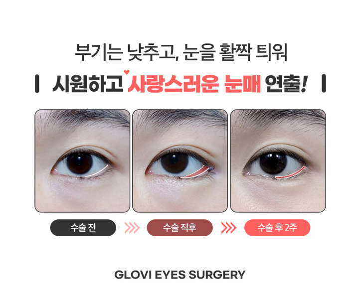 Worried About Re-adhesion After Lateral Canthoplasty? Those Concerns Disappear When the Surgical Technique Is Different image 5