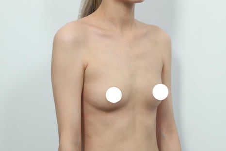 가슴확대수술, "어디서 해야 하나"보다 먼저 알아야 할 것들 관련 이미지 3