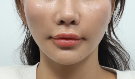 Sinsa Station Thread Lifting: What to Check When You’re Concerned About Skin Elasticity image 10