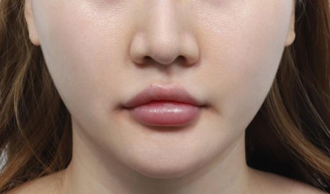 실리프팅 몇 줄이 적당한지 고민이라면 클릭 관련 이미지 4