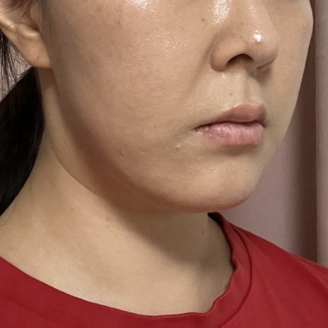 Thread-Lifting Side Effects: Changes That May Occur After the Procedure image 4