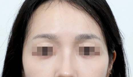 강남 눈밑지방재배치, 눈 밑 지방을 정리하는 방법 관련 이미지 9