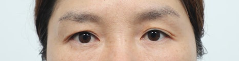 Lower Eyelid and Upper Eyelid Surgery: Should They Be Performed Together as You Age? image 2