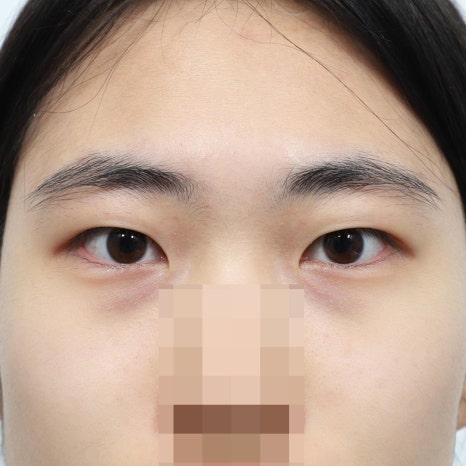 압구정 쌍수, 내 눈에 맞는 수술법 선택 가이드 관련 이미지 6