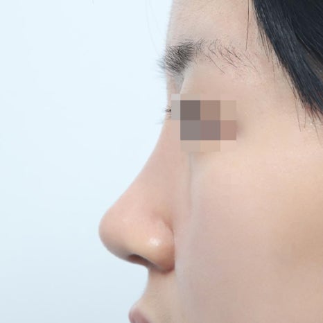 코성형 1개월 후 붓기 회복 상태와 일상생활 주의사항 관련 이미지 8