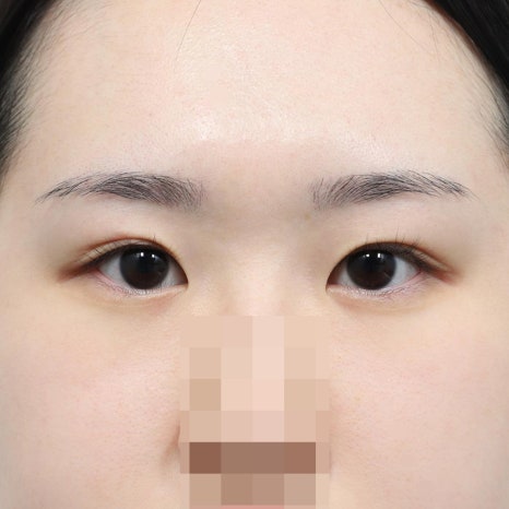 쌍꺼풀수술 재수술 시기, 언제 시작하는 게 좋을까? 관련 이미지 7