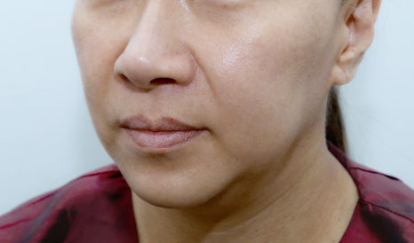 실리프팅주의사항, 시술 후 4주가 결과를 결정합니다 관련 이미지 8