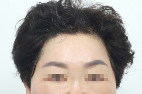 Lower Eyelid and Upper Eyelid Surgery: Should They Be Performed Together as You Age? image 5