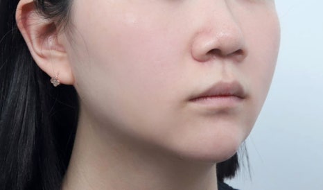 실리프팅 전후, 효과보다 먼저 알아야 할 것 관련 이미지 10