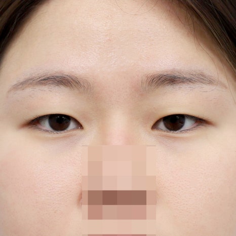 압구정 쌍수, 내 눈에 맞는 수술법 선택 가이드 관련 이미지 4