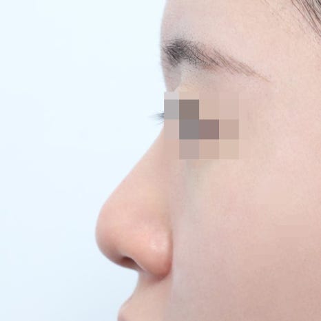The Cost of Rhinoplasty for Women: A Smart Choice Between Safety and Price image 7