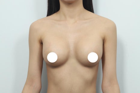 가슴수술 가격, 상담 받기 전에 반드시 확인해야 할 것들 관련 이미지 8