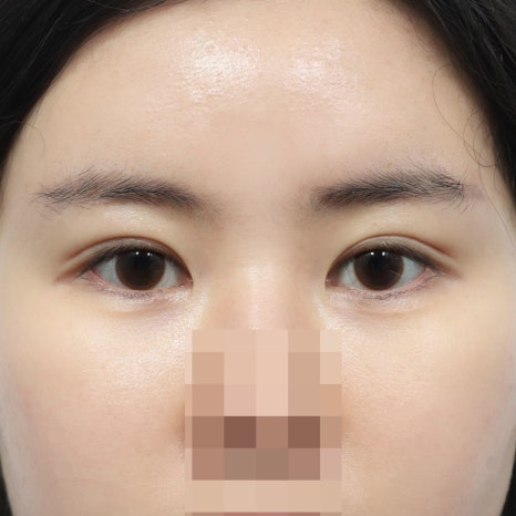 소세지눈 재수술, 무조건 빠를수록 좋다는 말이 맞을까요 관련 이미지 4