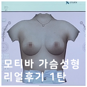 모티바가슴성형 리얼후기 1탄｜글로비성형외과의원 관련 이미지 1