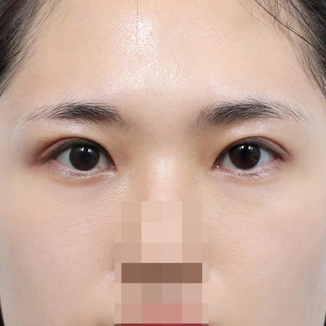 압구정 눈성형 후기 꼭 확인해야 할 체크포인트 관련 이미지 3