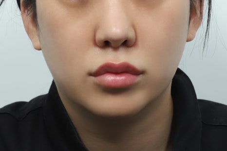 Philtrum Reduction Review: The Real Story No One Tells You image 4