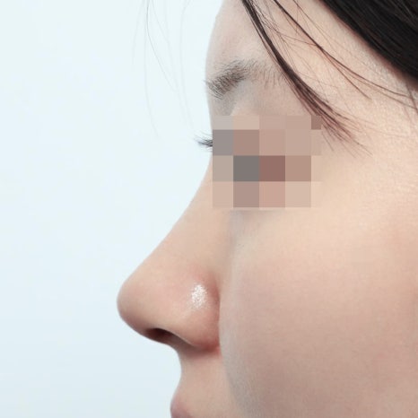 코성형후붓기, 수술 후 한 달이 가장 힘들다는 말, 진짜일까 관련 이미지 4