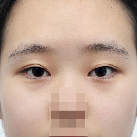 압구정 눈성형 후기 꼭 확인해야 할 체크포인트 관련 이미지 6