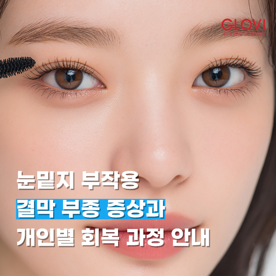 Side Effects of Lower Eyelid Fat Repositioning: Symptoms of Conjunctival Edema and Individual Recovery Processes image 1